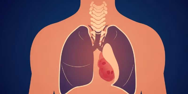 Mediastinal Tümör Tedavisinde VATS (Kapalı Göğüs Cerrahisi) Yöntemi